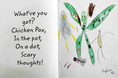 Chicken Pox